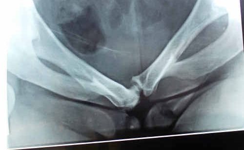 This X-ray of a 36-year-old Warwick woman’s angular pelvic bone is a tangible reminder of constant pain as she battles for the recognition of her condition and support from Queensland Health and Centrelink. This X-ray of a 36-year-old Warwick woman’s angular pelvic bone is a tangible reminder of constant pain as she battles for the recognition of her condition and support from Queensland Health and Centrelink.